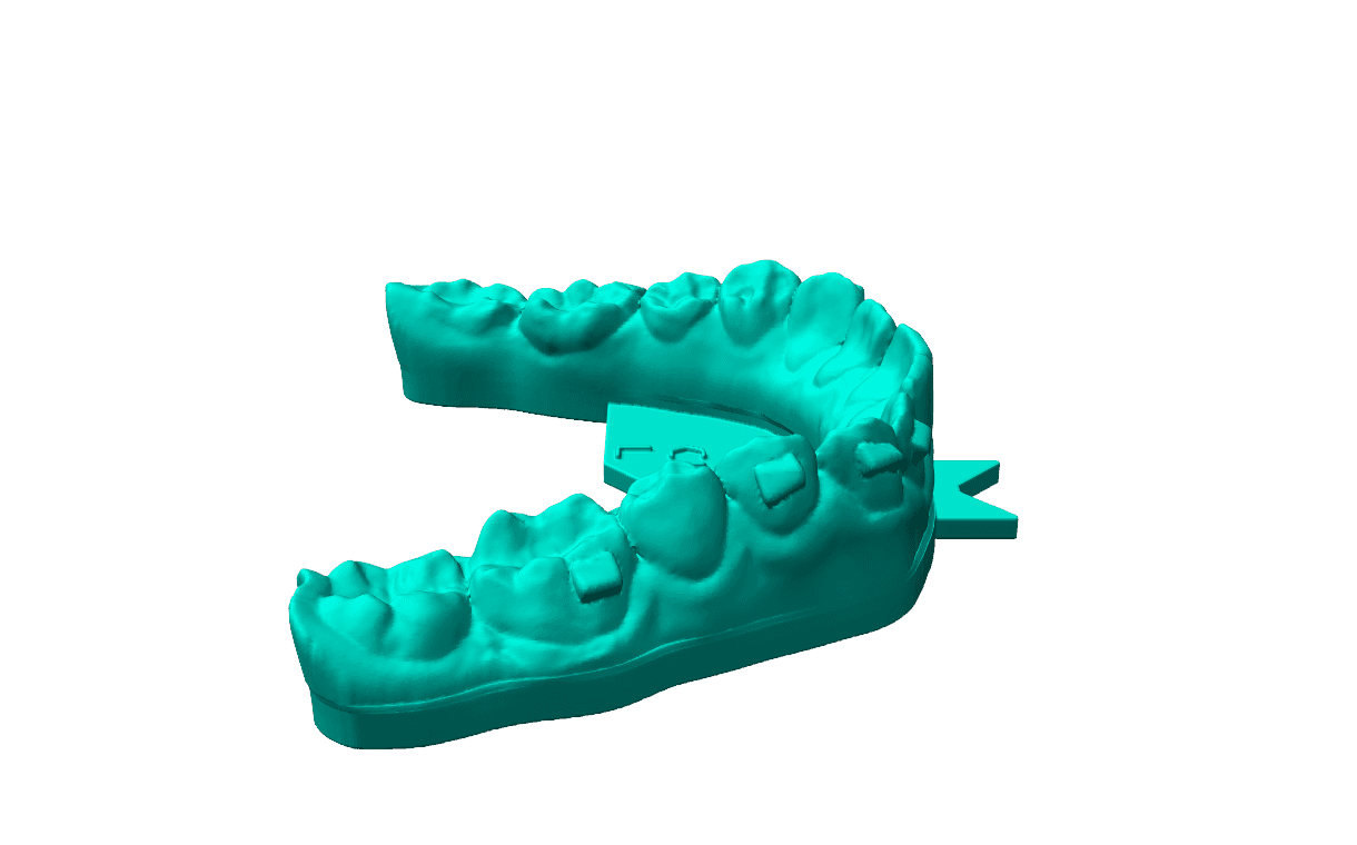 MoldLean-optimized dental aligner mold